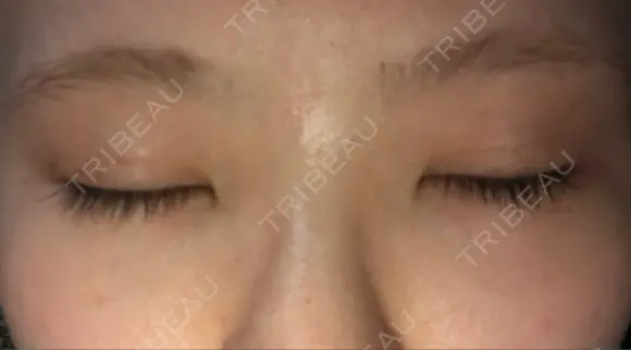 二重埋没 / 下まぶたの脂肪取り / ボトックス（エラ・小顔） 表参道スキンクリニック 表参道院 DAY 6 メイン用