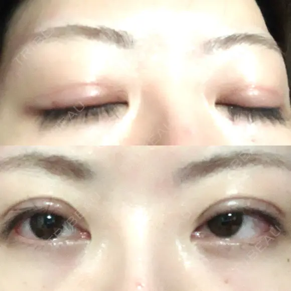 眼瞼下垂（切開） 札幌中央形成外科 DAY 17 メイン用