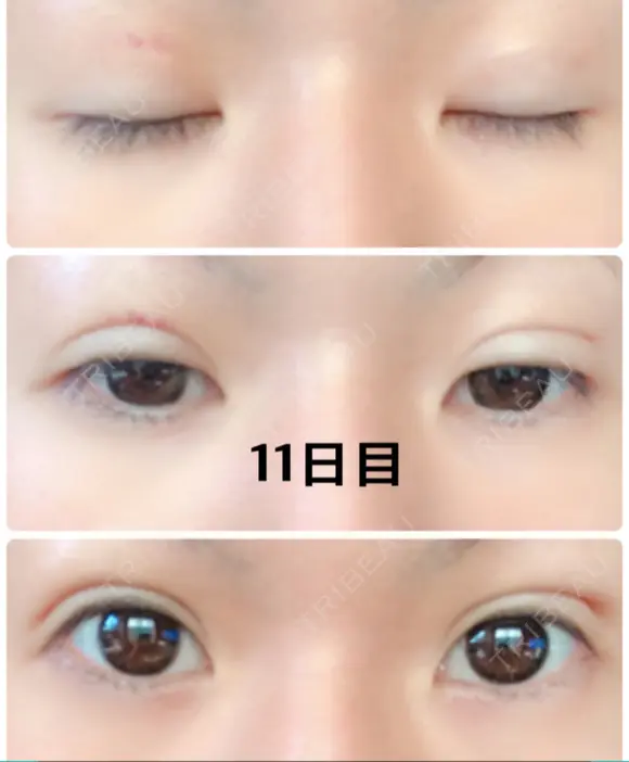 二重埋没 城本クリニック 姫路院 DAY 11 メイン用