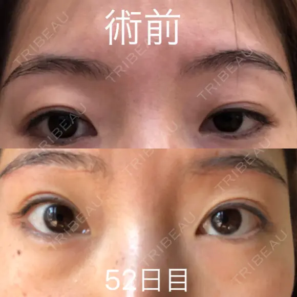 眉下切開 ビクアスクリニック DAY 52 メイン用