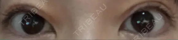 二重切開 / 上まぶたたるみ取り / 目元修正 神野美容形成外科クリニック AFTER メイン用