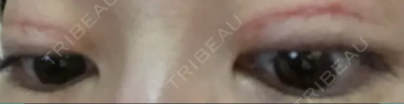 二重切開 / 上まぶたたるみ取り / 目元修正 神野美容形成外科クリニック DAY 30 メイン用