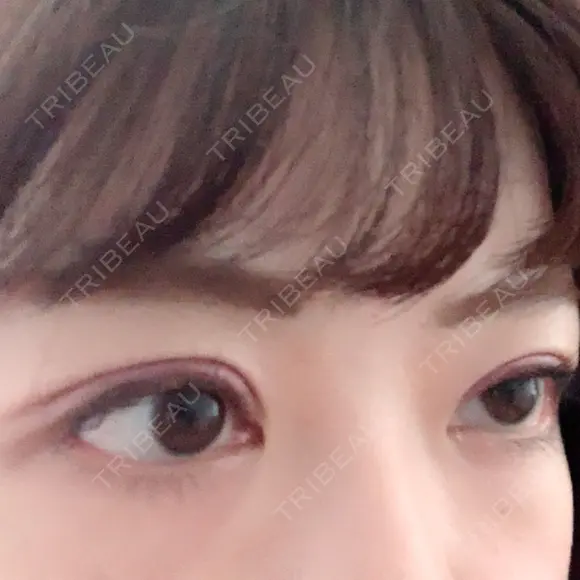 眼瞼下垂（切開） 札幌中央形成外科 DAY 19 メイン用