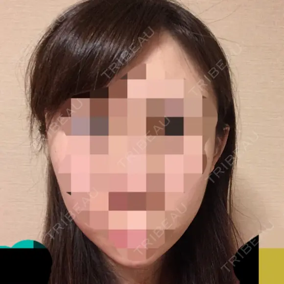 骨切り（あご） / 骨削り（エラ） / 骨削り（頬） ボンディ美容整形外科（旧リオン整形外科） DAY 53 メイン用