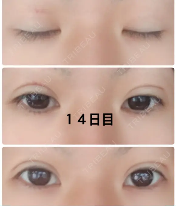 二重埋没 城本クリニック 姫路院 DAY 13 メイン用