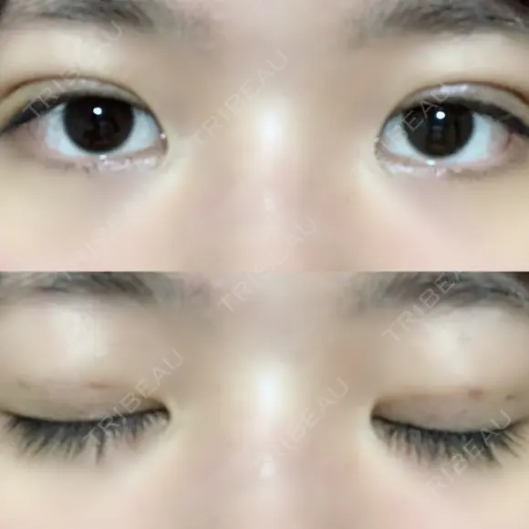 二重埋没 / 眼瞼下垂（切開） アリナガ美容外科 AFTER メイン用