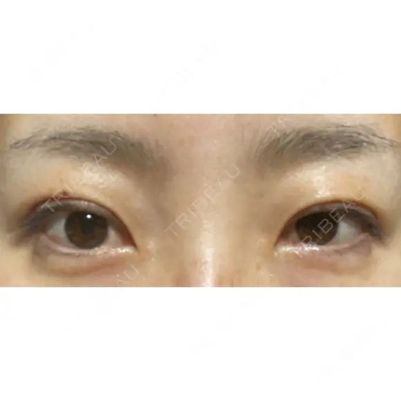 二重埋没 城本クリニック 姫路院 DAY 16 メイン用