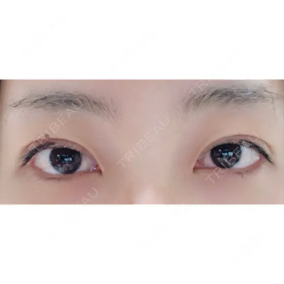 二重埋没 城本クリニック 姫路院 DAY 19 メイン用