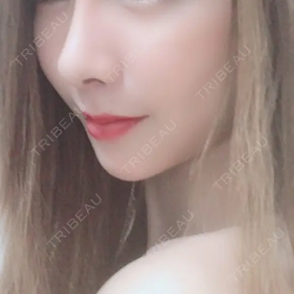 セットバック 大塚美容形成外科・歯科 大塚本院 DAY 53 メイン用