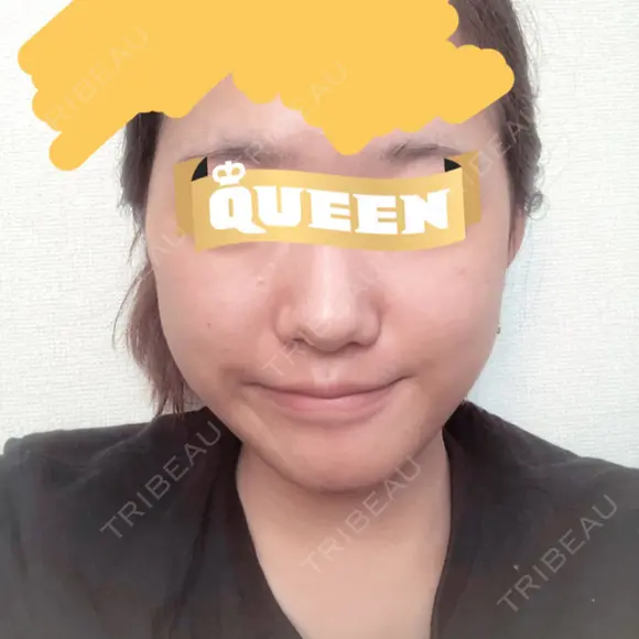 目頭切開 / バッカルファット除去 / 脂肪吸引（顔） / 目尻切開 / タレ目形成・グラマラスライン（切開） / その他（目元） RG整形外科（旧リオン整形外科） DAY 33 メイン用