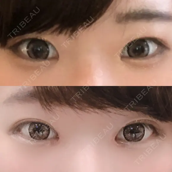 目頭切開 / バッカルファット除去 / 脂肪吸引（顔） / 目尻切開 / タレ目形成・グラマラスライン（切開） / その他（目元） RG整形外科（旧リオン整形外科） DAY 33 メイン用