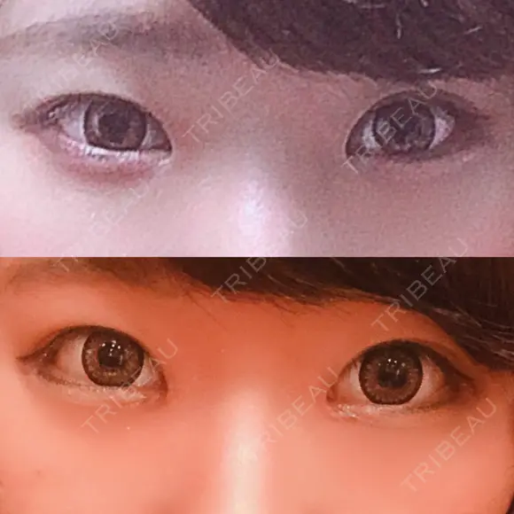 目頭切開 / バッカルファット除去 / 脂肪吸引（顔） / 目尻切開 / タレ目形成・グラマラスライン（切開） / その他（目元） RG整形外科（旧リオン整形外科） DAY 33 メイン用