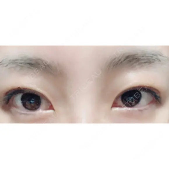 二重埋没 城本クリニック 姫路院 DAY 21 メイン用