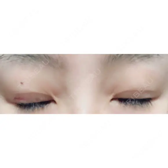 二重埋没 城本クリニック 姫路院 DAY 21 メイン用