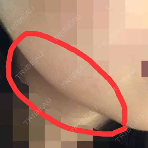 骨切り（あご） / 骨削り（エラ） / 骨削り（頬） ボンディ美容整形外科（旧リオン整形外科） DAY 53 メイン用