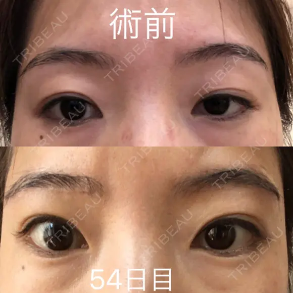 眉下切開 ビクアスクリニック DAY 54 メイン用
