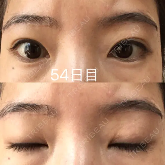 眉下切開 ビクアスクリニック DAY 54 メイン用