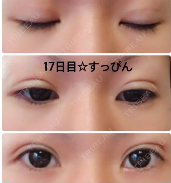 二重埋没 城本クリニック 姫路院 DAY 16 メイン用