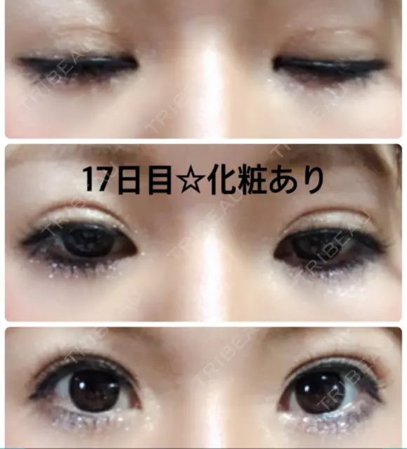 二重埋没 城本クリニック 姫路院 DAY 16 メイン用