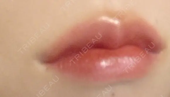 ボトックス（エラ・小顔） / 脂肪溶解注射（顔） / ヒアルロン酸注入（唇） / ボトックス（口角） the way（ザウェイ）整形外科 AFTER メイン用