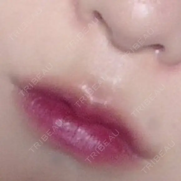 ボトックス（エラ・小顔） / 脂肪溶解注射（顔） / ヒアルロン酸注入（唇） / ボトックス（口角） the way（ザウェイ）整形外科 DAY 17 メイン用