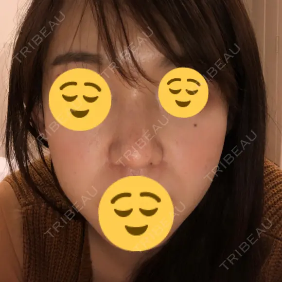 鼻尖形成（切開） / 鼻中隔延長（切開） / 小鼻縮小（切開） / 軟骨移植 / 骨切幅寄せ HANABI整形外科 DAY 201 メイン用