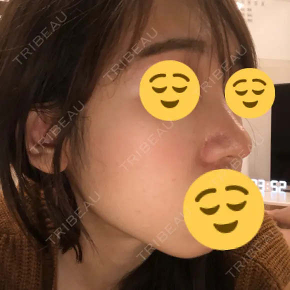 鼻尖形成（切開） / 鼻中隔延長（切開） / 小鼻縮小（切開） / 軟骨移植 / 骨切幅寄せ HANABI整形外科 DAY 201 メイン用