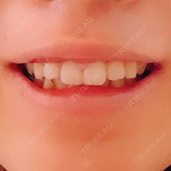 ガミースマイル手術 / その他（口元） 美容皮膚科ピュアビューティー恵比寿 DAY 13 メイン用