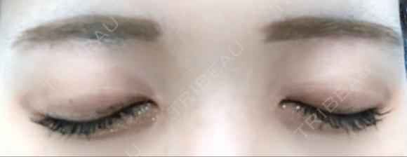 その他（目元） / 眉下切開 湘南美容クリニック 秋葉原院 DAY 30 メイン用