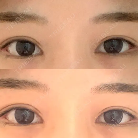 ボトックス（タレ目） フィラークリニック 新宿院 DAY 0 メイン用