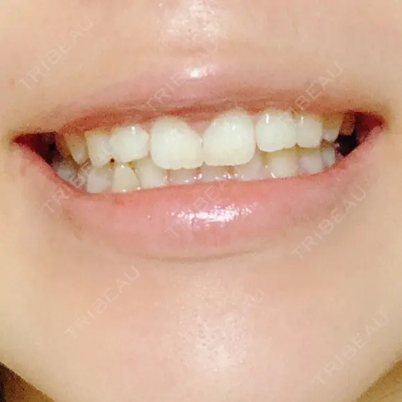 ガミースマイル手術 / その他（口元） 美容皮膚科ピュアビューティー恵比寿 DAY 15 メイン用