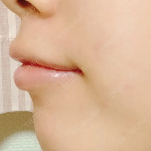 ガミースマイル手術 / その他（口元） 美容皮膚科ピュアビューティー恵比寿 DAY 15 メイン用