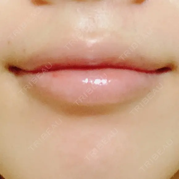 ガミースマイル手術 / その他（口元） 美容皮膚科ピュアビューティー恵比寿 DAY 15 メイン用