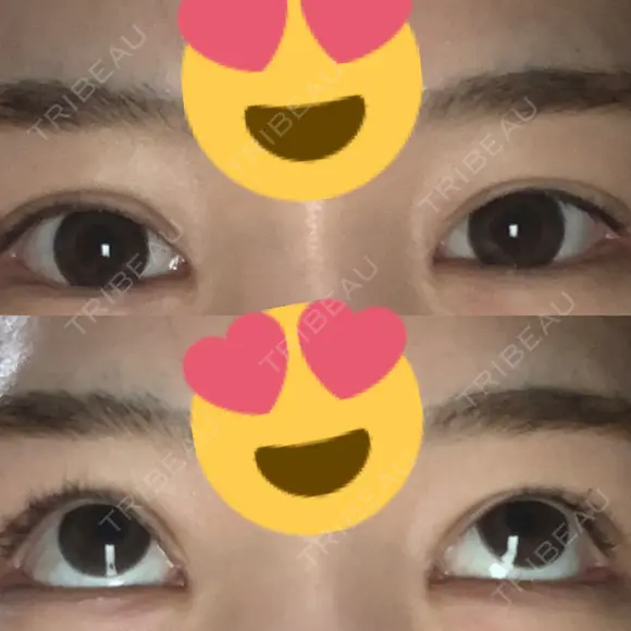 ボトックス（タレ目） フィラークリニック 新宿院 DAY 2 メイン用