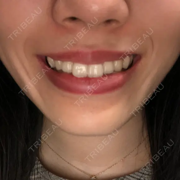 ガミースマイル手術 有楽町美容外科クリニック AFTER メイン用