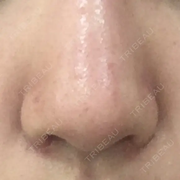 小鼻縮小（切開） 東京ヒルズクリニック 新宿院 DAY 8 メイン用