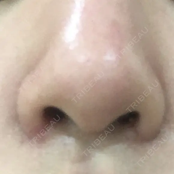 小鼻縮小（切開） 東京ヒルズクリニック 新宿院 DAY 8 メイン用