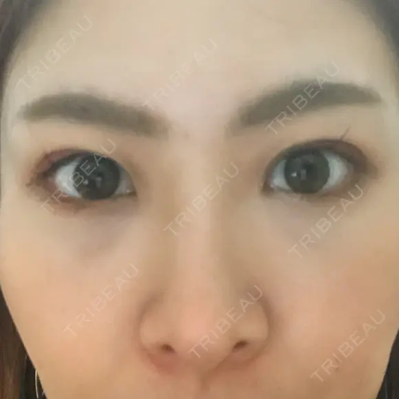 二重埋没 藤・ナチュレ美容クリニック 恵比寿院 DAY 7 メイン用