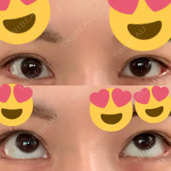 ボトックス（タレ目） フィラークリニック 新宿院 DAY 3 メイン用