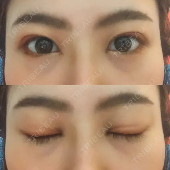 二重埋没 藤・ナチュレ美容クリニック 恵比寿院 DAY 8 メイン用