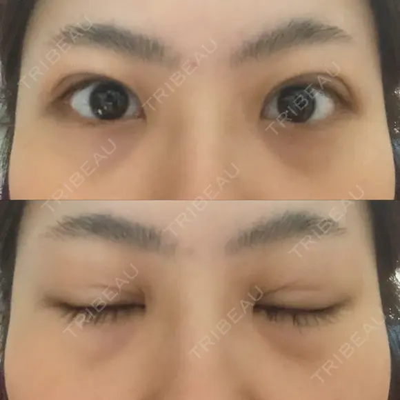 二重埋没 藤・ナチュレ美容クリニック 恵比寿院 DAY 8 メイン用