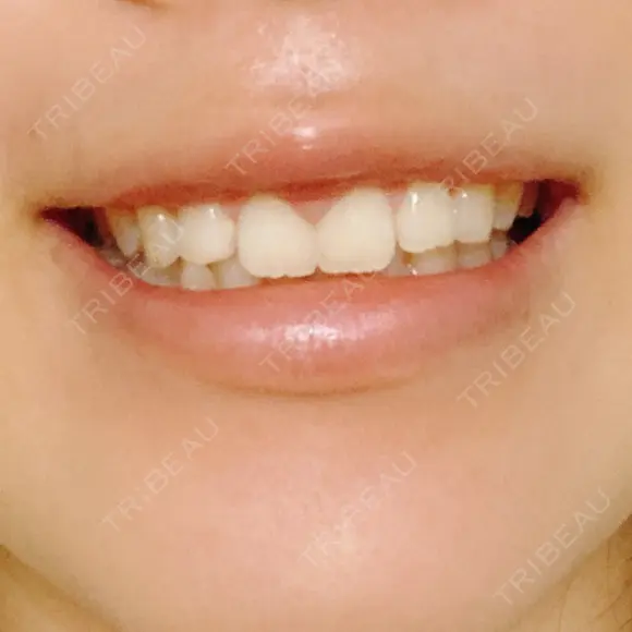 ガミースマイル手術 / その他（口元） 美容皮膚科ピュアビューティー恵比寿 DAY 16 メイン用