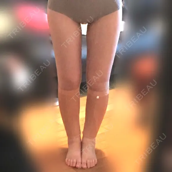 ボトックス（ふくらはぎ） / その他（ボディ） プチパーティー医院 DAY 6 メイン用