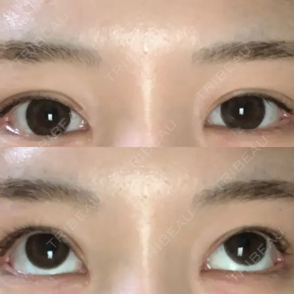 ボトックス（タレ目） フィラークリニック 新宿院 AFTER メイン用