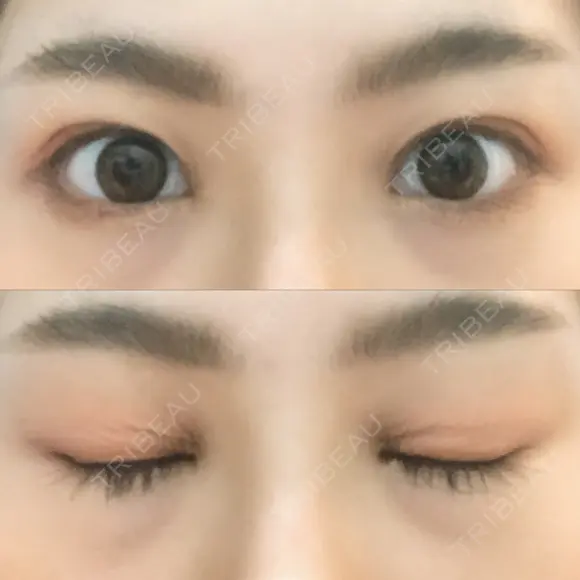 二重埋没 藤・ナチュレ美容クリニック 恵比寿院 DAY 9 メイン用