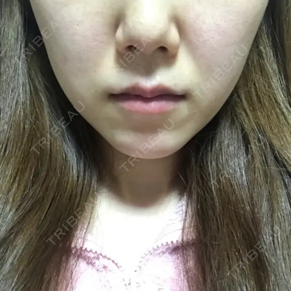 脂肪溶解注射（顔） / その他（肌） The-Clim産婦人科  DAY 3 メイン用