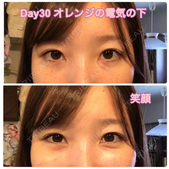 クマ治療 / 下まぶたたるみ取り / 下まぶたの脂肪取り セオリークリニック DAY 30 メイン用