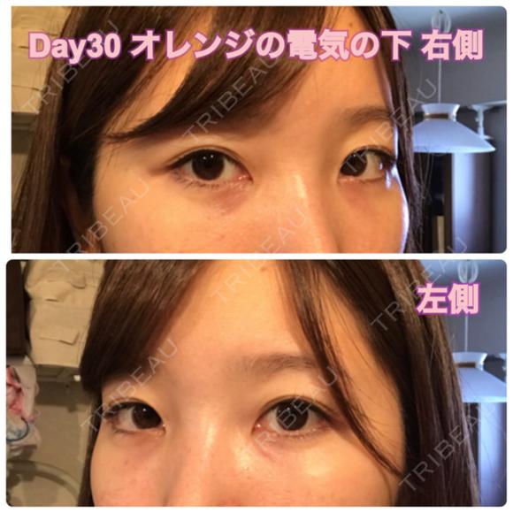 クマ治療 / 下まぶたたるみ取り / 下まぶたの脂肪取り セオリークリニック DAY 30 メイン用