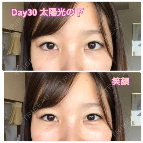 クマ治療 / 下まぶたたるみ取り / 下まぶたの脂肪取り セオリークリニック DAY 30 メイン用