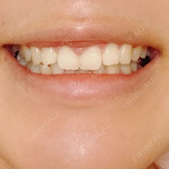 ガミースマイル手術 / その他（口元） 美容皮膚科ピュアビューティー恵比寿 DAY 18 メイン用